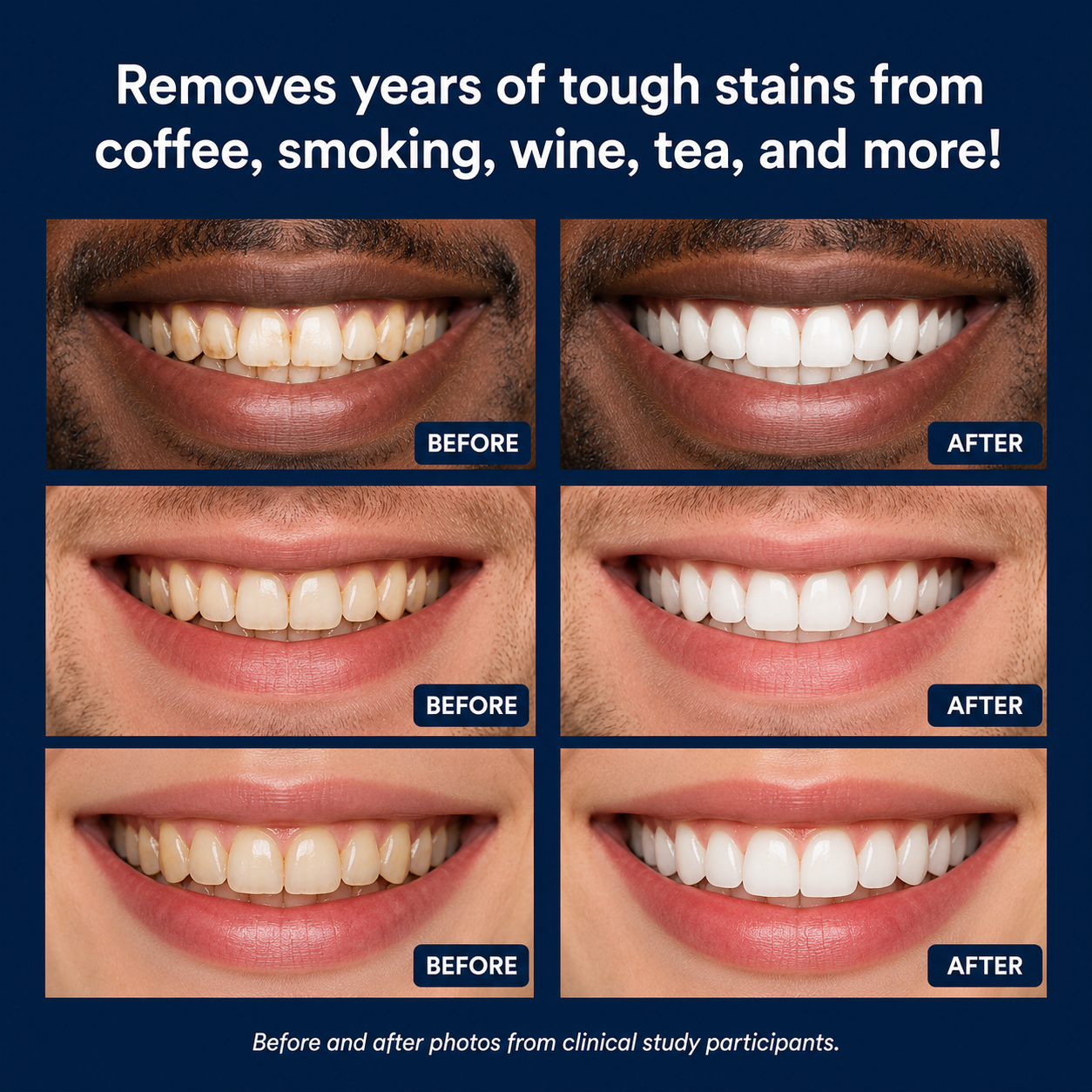 Teeth Whitening Pen
